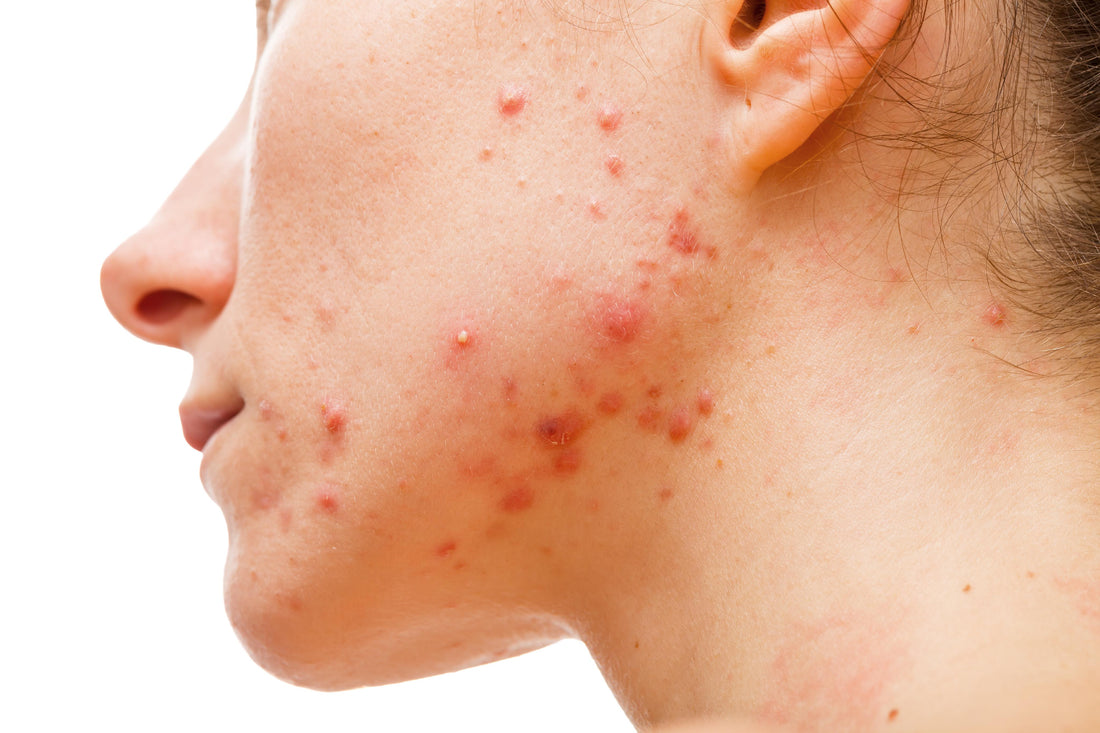 Why We Still Break Out in Our 40s and 50s: Understanding Adult Acne