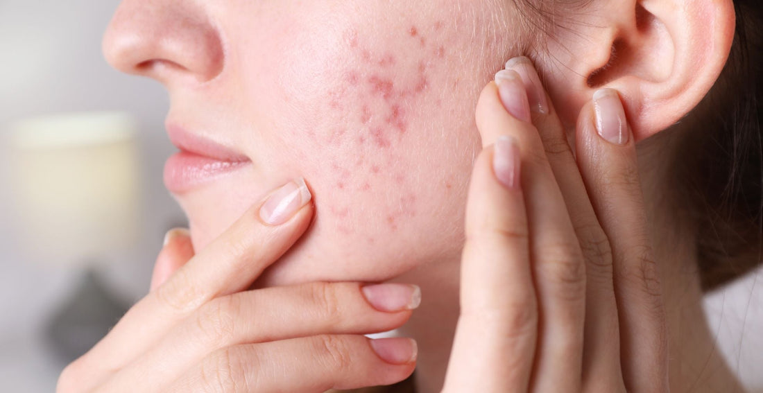 Treatment for adult acne 